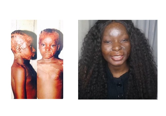 Ennek a lánynak teljesen összeégett az arca, de úgy megtanult sminkelni, hogy nem hiszed el, amit látsz!