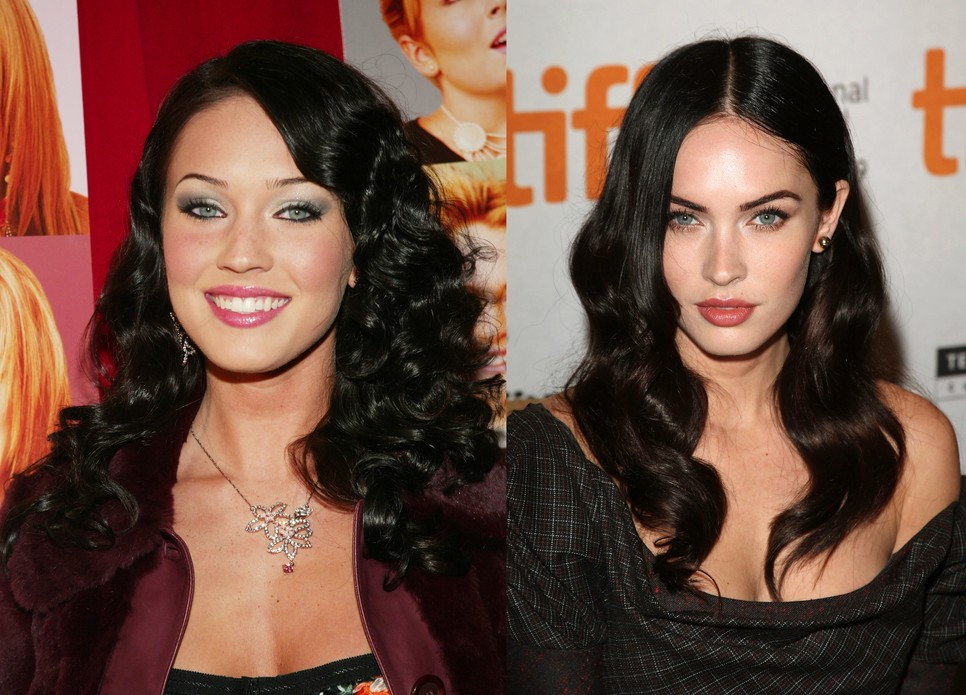 Kifejezetten undorító plasztikai műtét a sztárok hangsúlyos arccsontjának titka