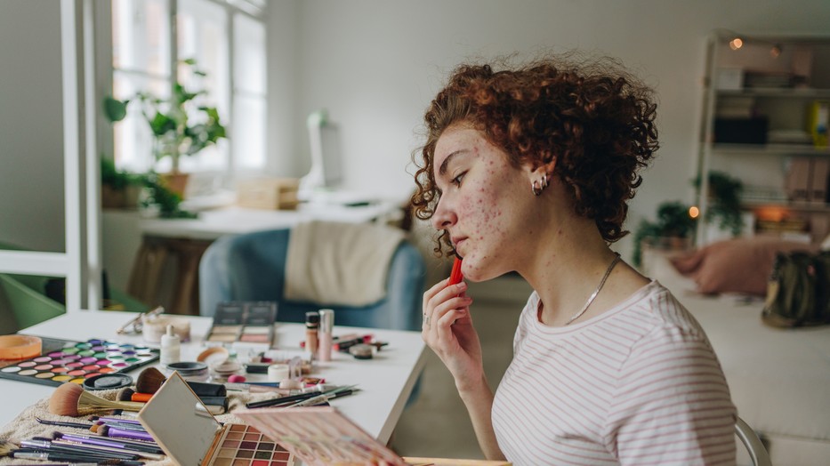 Ezt jelenti, ha mindig ugyanott jelennek meg a pattanásaid