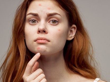 13 dolog, amiről nem gondolnád, mégis sokat árt az arcbőrödnek