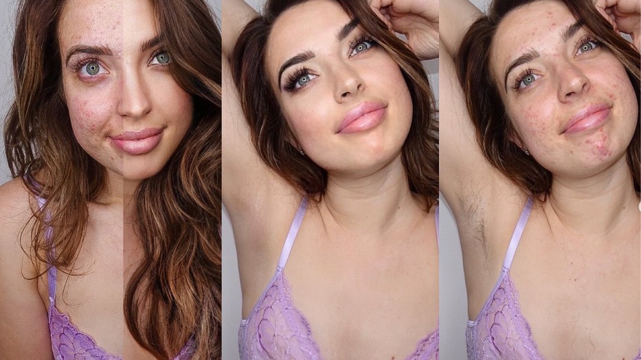 Bekki szeretné normalizálni online jelenlétével azt, amit sokan borzalmasnak tartanak: a szőrzetet és a pattanásokat