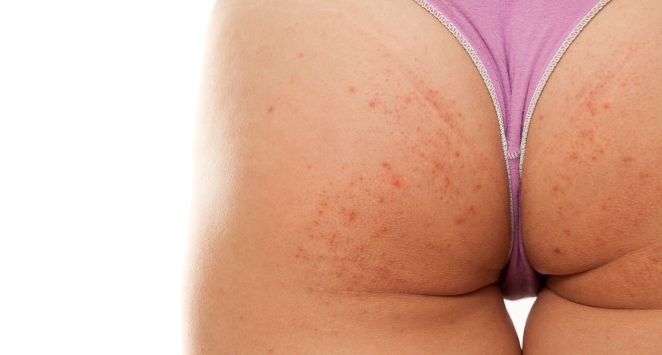 A fenéken megjelenő pattanásokat számos tényező kiválthatja