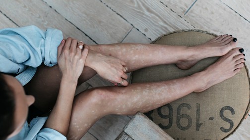 Pikkelysömöröd van? Ha teszel érte, tünetmentesen élhetsz!