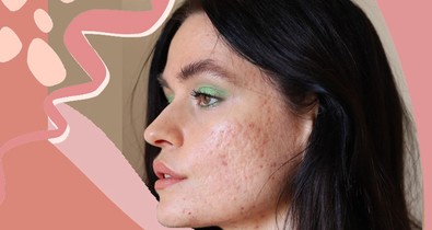 5 dolog, amit bárcsak tudtam volna a pattanásokról 18 évesen