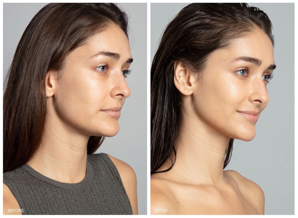 03 FOREO BEAR 2™ Before and After