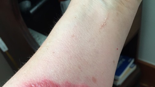 Vigyázat! Ezek az iPhone tokok égési sérüléseket okoztak!