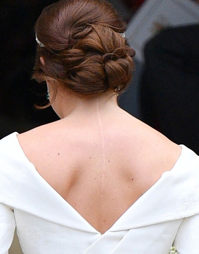 Hű: Eugénia hercegnő szándékosan mutatta meg műtéti hegét az esküvőjén