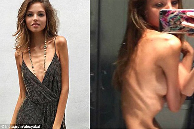 jevgenyij kafelnyikov, anorexia, betegség, modell, orosz modell, aleysa kafelnyikov, sovány, csontsovány, fogyás, debütálás, tenisz, teniszező