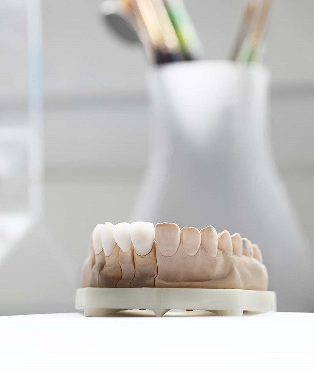 A préskerámia-korona szükségessége