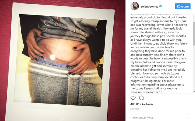 Selena Gomez veseátültetésen esett át! Instagramon jelentette be!