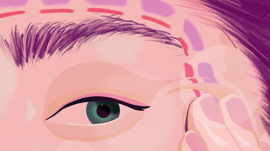 Filler-teória: tudj meg többet az esztétikai és plasztikai beavatkozásokról!