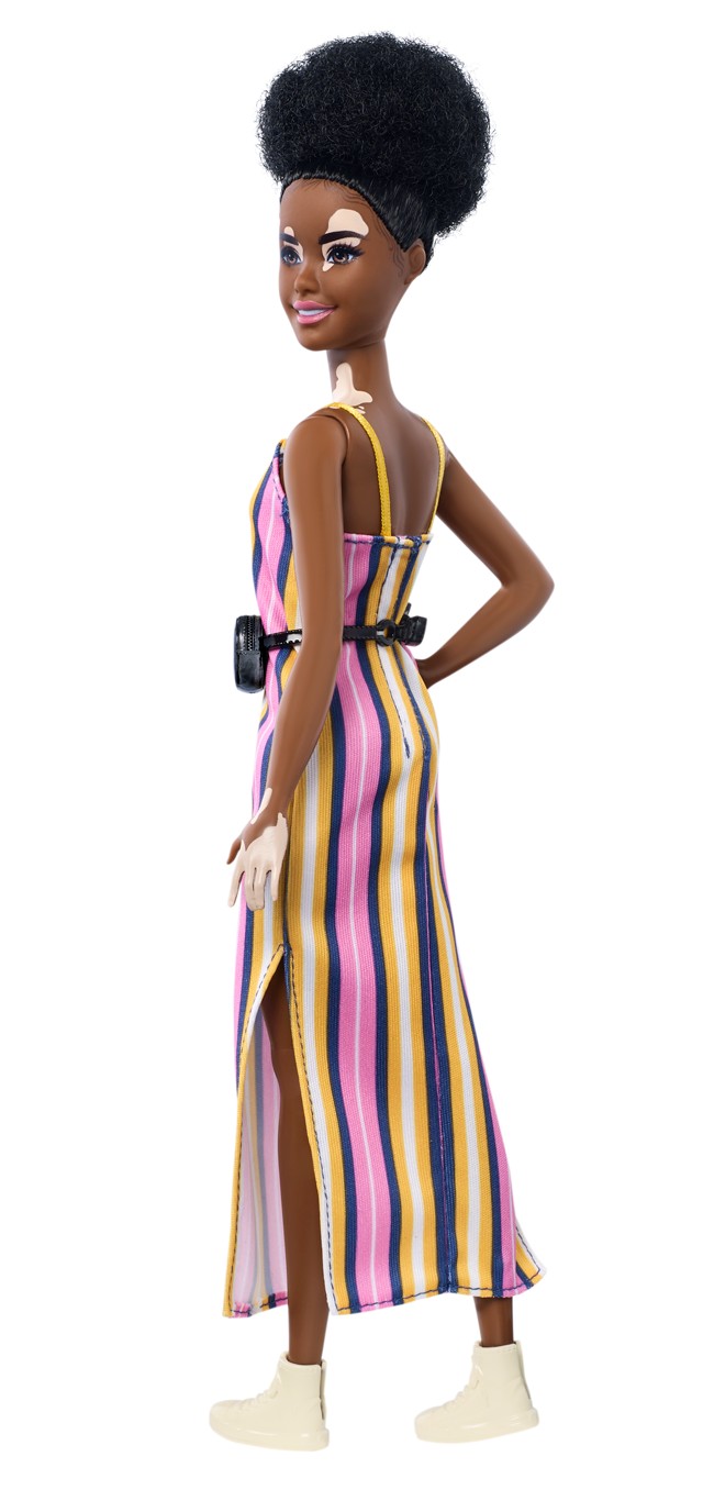 Vitiligós babával bővíti sokszínű kollekcióját a Barbie