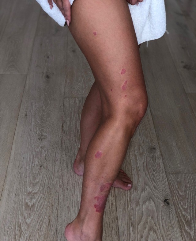 Kim Kardashian lábán a pikkelysömör tünetei